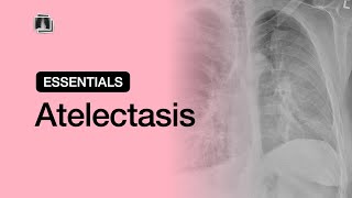 Atelectasis  Chest Radiology Essentials [upl. by Ateekram707]