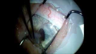 Lamelar Keratoplasty followed by a xenotransplant Frozen cornea [upl. by Treb]