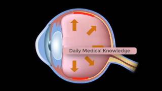 Development of Glaucoma Animation Open Angle vs Angle Closure Glaucoma [upl. by Renner]