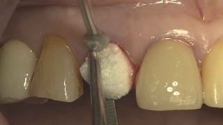 Immediate implantation with flapless simple grafting on upper anterior area [upl. by Nanreit]