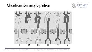 Arteritis de Takayasu [upl. by Eentrok]