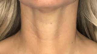 Scarless Thyroidectomy  Transoral Endoscopic Thyroidectomy Vestibular Approach [upl. by Slerahc]