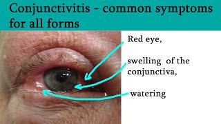 Red or pink eye  Conjunctivitis symptoms and treatment [upl. by Bastien]