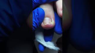 Removing ingrown toenail nails pedicure satisfying ingrownails [upl. by Goldsworthy415]