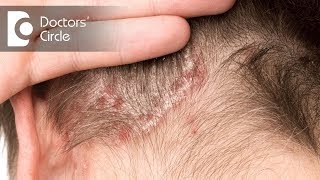 Treatment options for Scalp Psoriasis  Dr Rashmi Ravindra [upl. by Urbano]