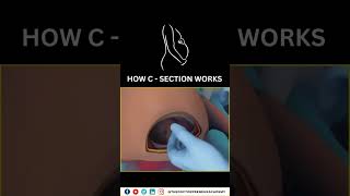 Cesarean Section Explained Why Doctors Choose CSections for a Safer Birth 👶✂️ Cesarean Birth [upl. by Voorhis799]