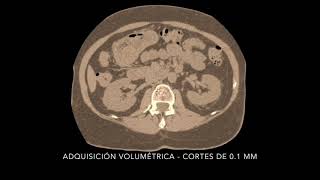 Osirix MD Tomografía de columna lumbar [upl. by Neisa]