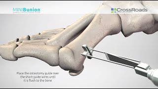 Minimally Invasive Bunion Surgery with CrossRoads MINIBunion™ System  Surgical Animation [upl. by Annoerb]