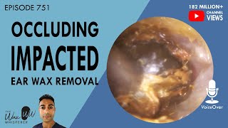 751  Occluding Impacted Ear Wax Removal [upl. by Philbert]