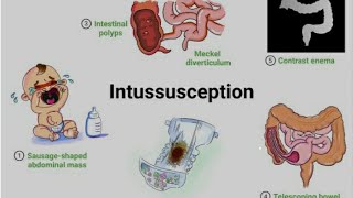 Intussusception with Homoeopathic management [upl. by Reena]