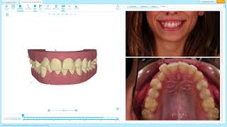 Invisalign Tips Clincheck review Deep Bite and aesthetics [upl. by Cis]