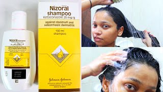 How to use Nizoral shampoo for effective results [upl. by Pagas]