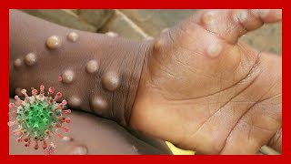 Monkeypox Overview and Symptoms MONKEYPOX CASES DETECTED IN US [upl. by Etoile]