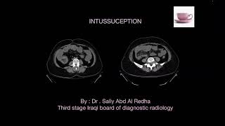 Intussusception [upl. by Arakaj]