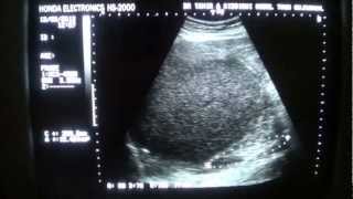 ULTRASOUND PERINEPHRIC ABSCESS RT [upl. by Lladnek]