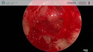 Resection of Pituitary Adenoma via transnasal transspheonidal approach Minimally Invasive Surgery [upl. by Yemac]