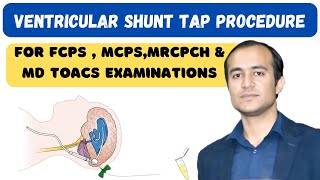 Ventriculoperitoneal Shunt Tap Procedure amp Blockage Diagnosis  shunt patency and radiology [upl. by Rhody]