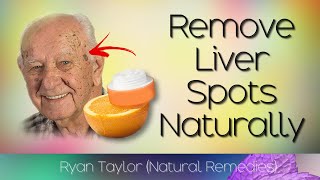 Remove Liver Spots Naturally Age Spots Natural Remedies [upl. by Barthol286]