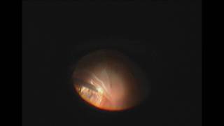 Vitrectomy and Perfluoron for Retinal Detachment with Giant Retinal Tear [upl. by Nyrret981]