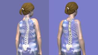 What is Scoliosis surgery [upl. by Noitsuj]