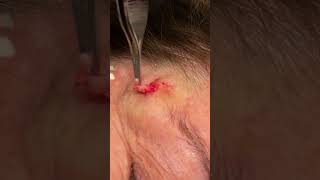 SMALL FACE CYST [upl. by Adnolehs]