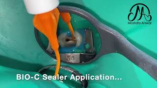 BIOC Sealer Application in Confluent Root Canals  How to Apply BioCeramic Sealer for Obturation [upl. by Yorle251]