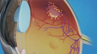 Prophylactic Laser Photocoagulation Laserpexy for Retinal Tear [upl. by Haida47]