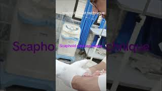 Scaphoid cast technique [upl. by Naloc]