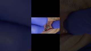 5 implants to replace lower premolars and molars with basal implants post 6 months tapping test [upl. by Chappelka592]