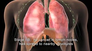 English MAKNA Getting to know Lung Cancer [upl. by Dranoel]