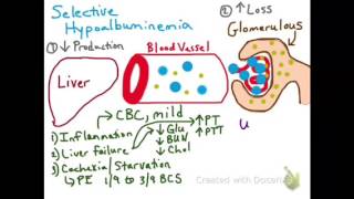 Selective Hypoalbuminemia [upl. by Zailer490]