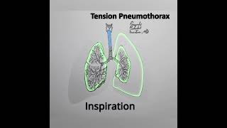 Tension Pneumothorax Animation variation 4 shorts medical [upl. by Floris]