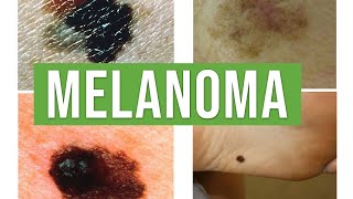 Melanoma vs Benign Melanocytic Nevus  Lecturio Dermatology [upl. by Even]