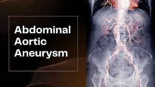 Abdominal Aortic Aneurysm [upl. by Mylan]