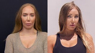 Woman Unhappy With Forehead Size Gets Reduction Surgery [upl. by Accissej379]