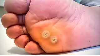 How To Remove a Foot Corn or Callus Foot Doctor Home Treatment [upl. by Brackett]