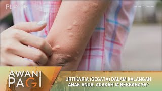 AWANI Pagi Urtikaria gegata dalam kalangan anak anda Adakah ia berbahaya [upl. by Priscilla]