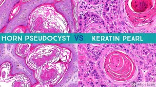 Keratin Pearl SCC vs Horn Pseudocyst SK aka quotpseudohorn cystquot [upl. by Tabina]