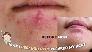 How I cleared by Hormonal Acne amp Scars [upl. by Aneehsit]