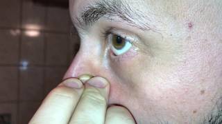 Komedo extrahieren blackheads und whiteheads bekämpfen Mitesser entfernen mit Ring Anleitung [upl. by Durkin266]