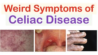 Weird Symptoms of Celiac Disease  Atypical Clinical Features [upl. by Aenej716]