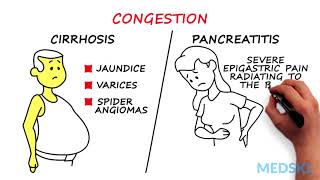 Splenomegaly Remember the 3 primary causes with CIP [upl. by Bj245]