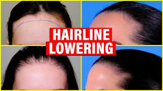 Hairline Lowering Hair Transplant vs Surgical Hairline Advancement [upl. by Avis]