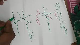 ECG changes in Hyperkalemia [upl. by Aitnahc]