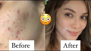 Spironolactone before and after  How I cleared hormonal acne  Products I used  Clindamycin [upl. by Mcwilliams]