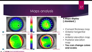 How to read MS39 AS OCT Corneal Topography DrYasser RIFAY  ENGLISH  Phoenix 37 [upl. by Misaq]