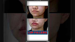 Get READY for Plump Lips with Lip Fillers  Sarayu Clinics filler [upl. by Charlotta]