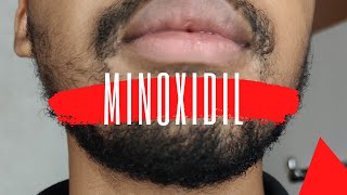 MINOXIDIL BARBE  Evolution après 1 mois de KIRKLAND [upl. by Idram355]