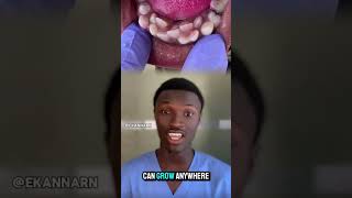 Hyperdontia is a condition where a person has extra teeth known as supernumerary teeth hyperdontia [upl. by Tillinger]