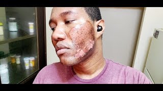 TCA Peel Day 3How to Remove Acne Scars and Hyperpigmentation [upl. by Munroe57]